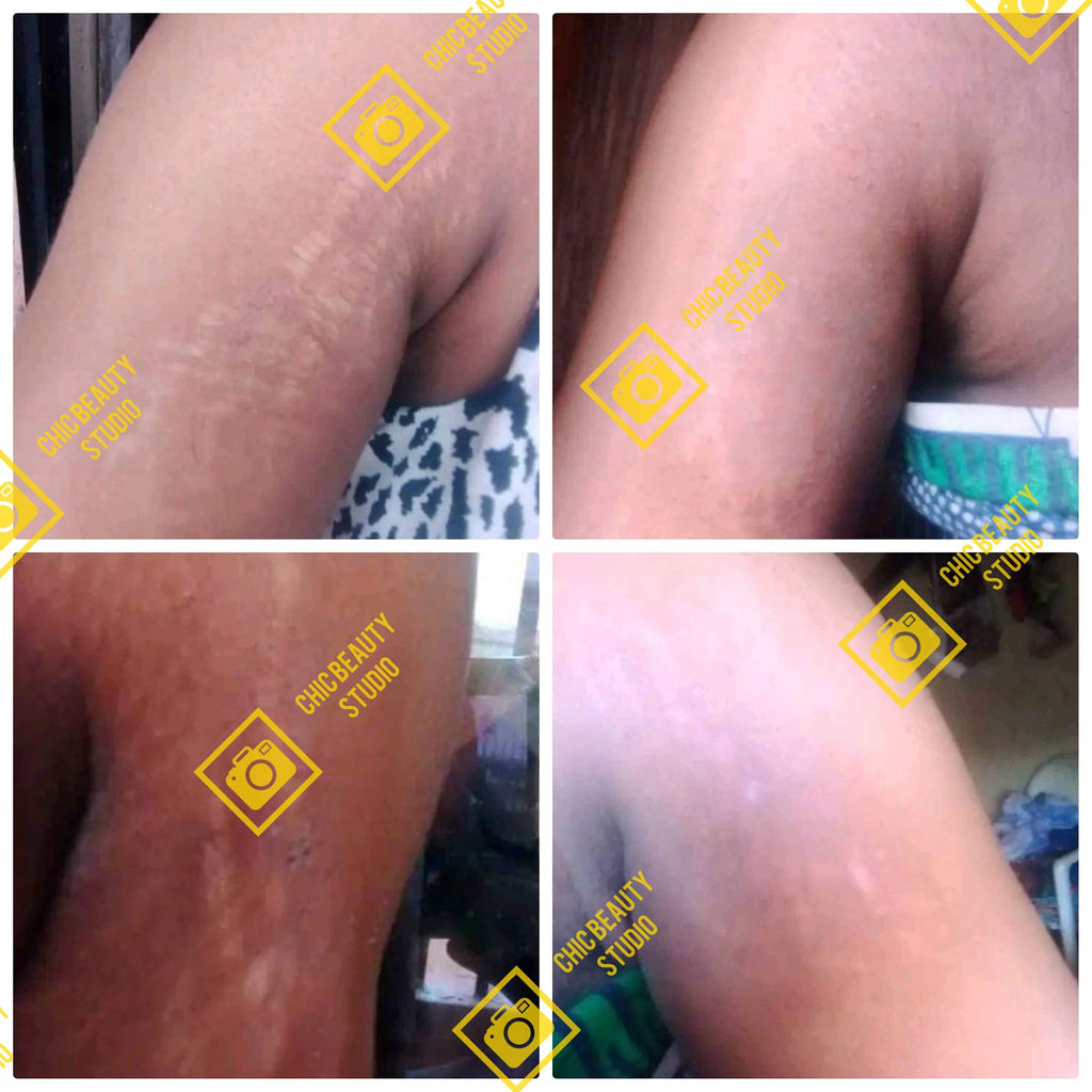 woman massaging stretchmark soap and oil on arms to  remove stretchmarks  south africa