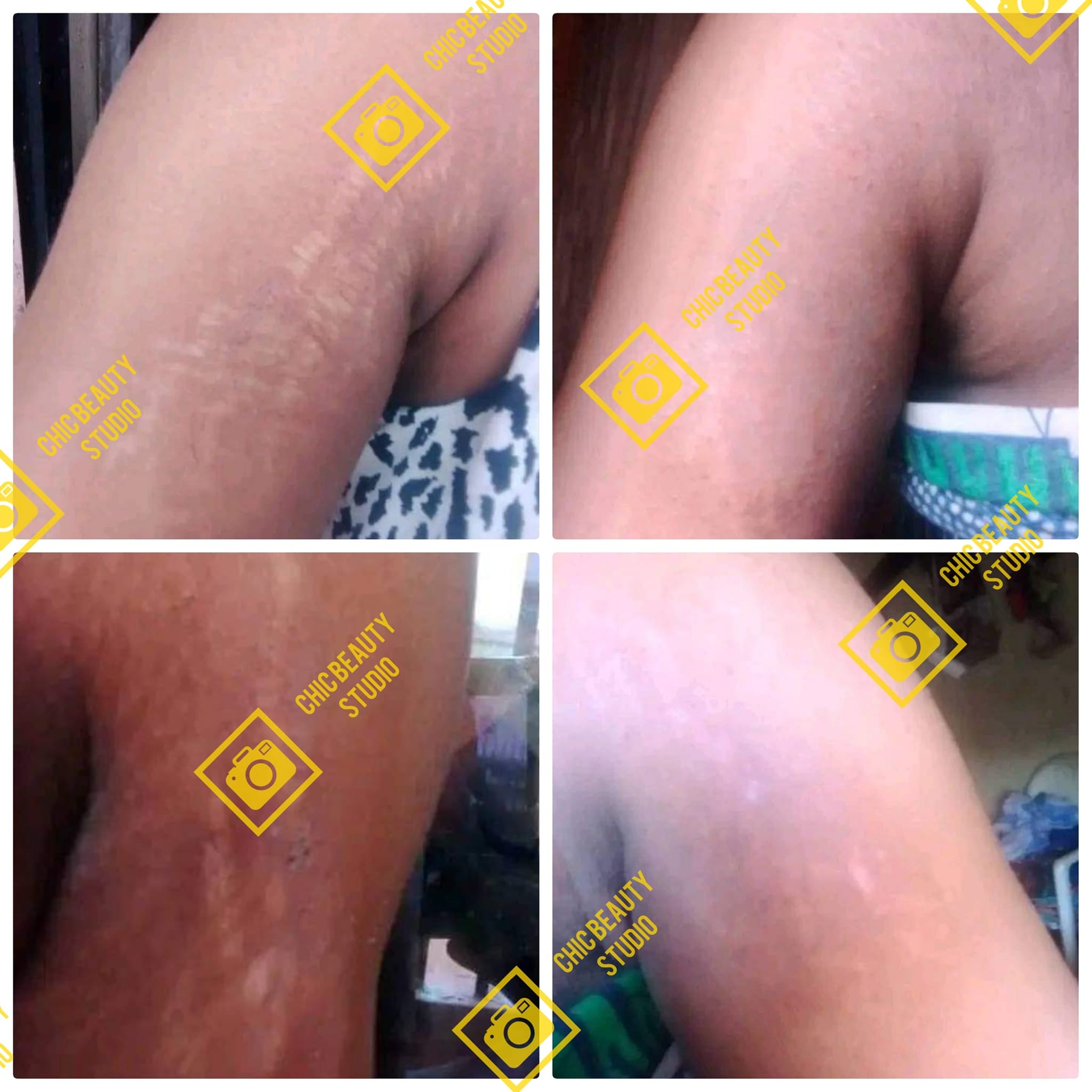 woman massaging stretchmark soap and oil on arms to  remove stretchmarks  south africa